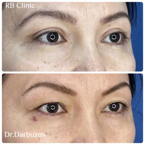 Блефаропластика до и после, работа доктора Дарбузова